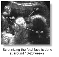 Scrutinizing the fetal face is done at around 18-20 weeks