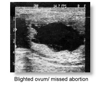 Blighted ovum/missed abortion