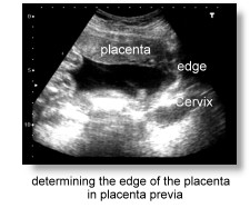 determining the edge of the placenta in placenta previa